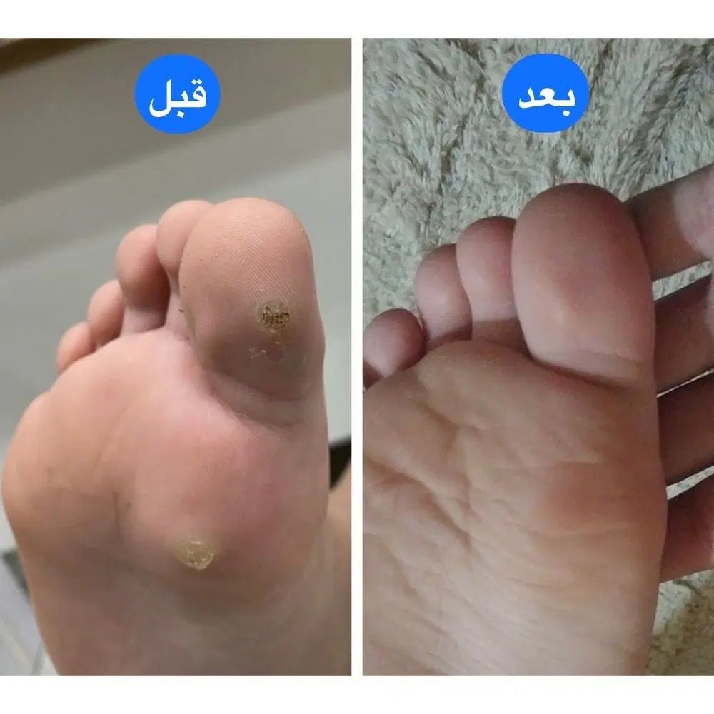 بهبودی زگیل تناسلی بدونه نیاز به فریز