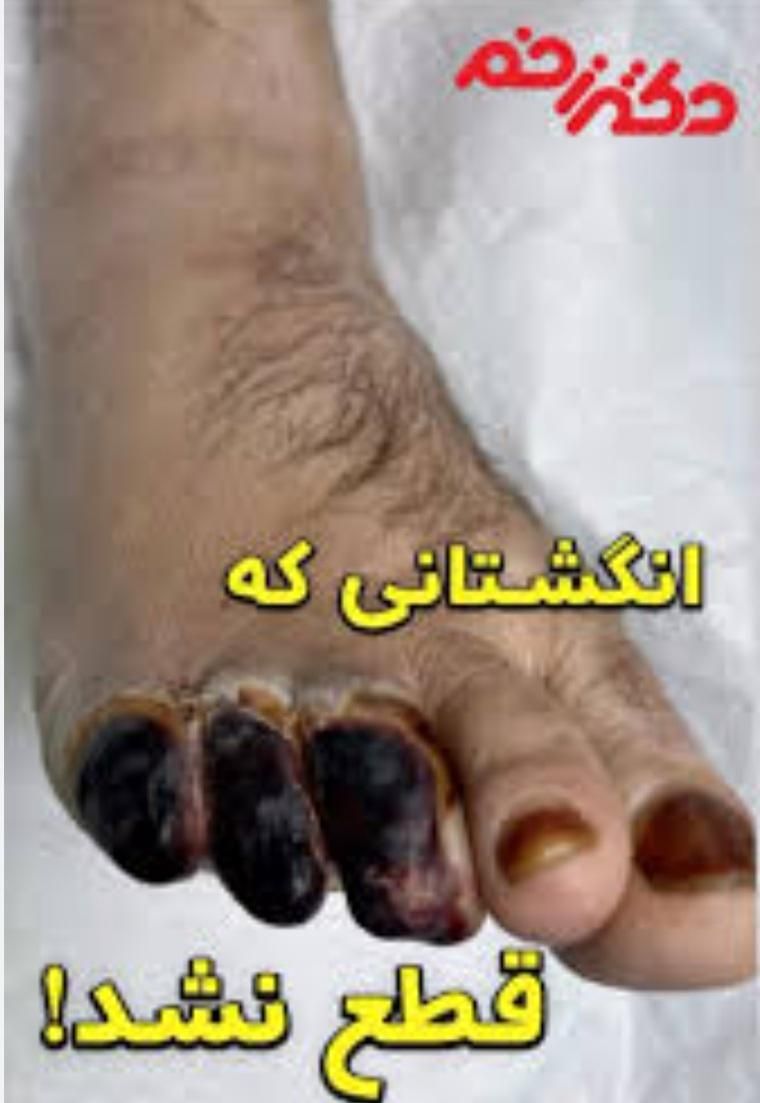 بهبودی دیابت بدونه نیاز به قرص