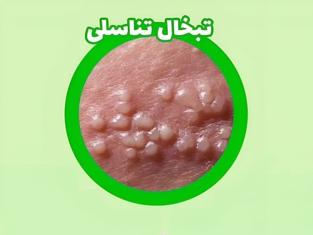 سلامت hpv