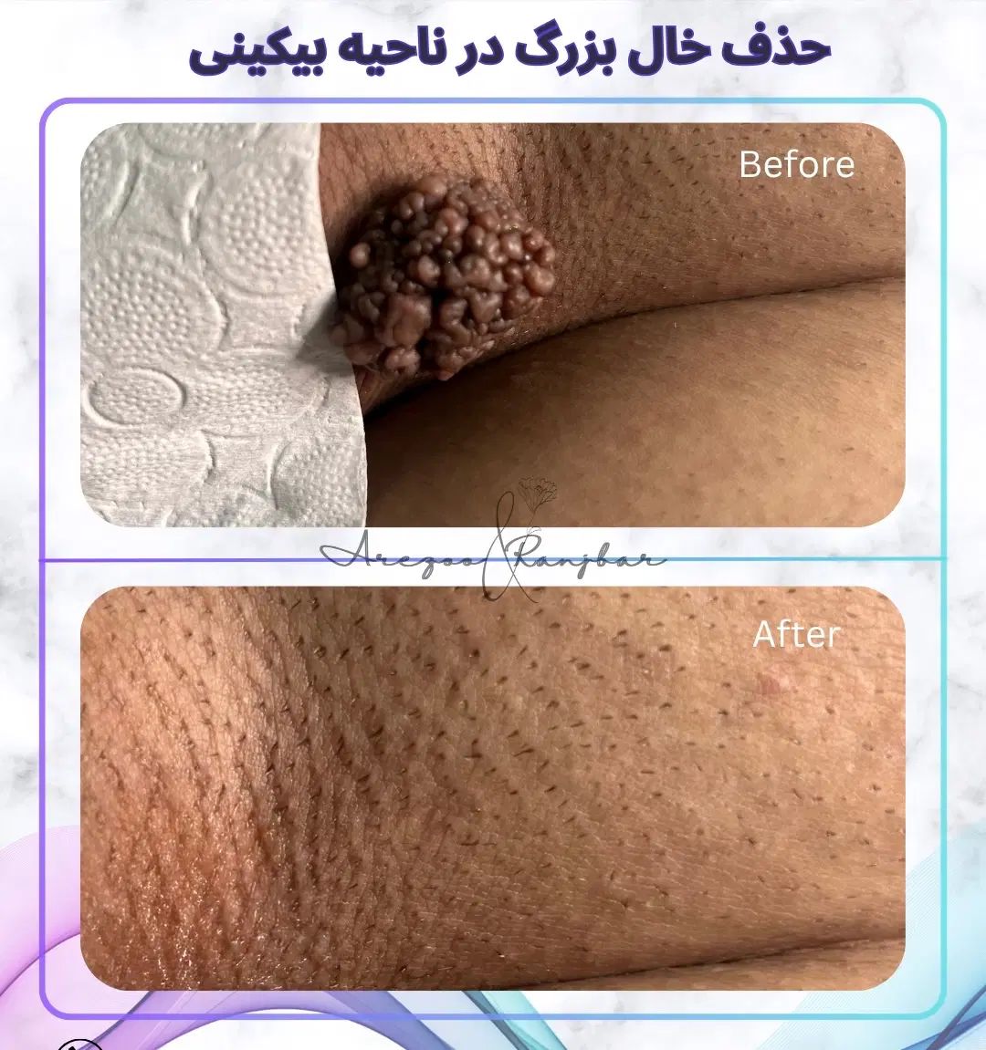 مشاوره رایگان **زگیل تناسلی آقایان و بانوان**