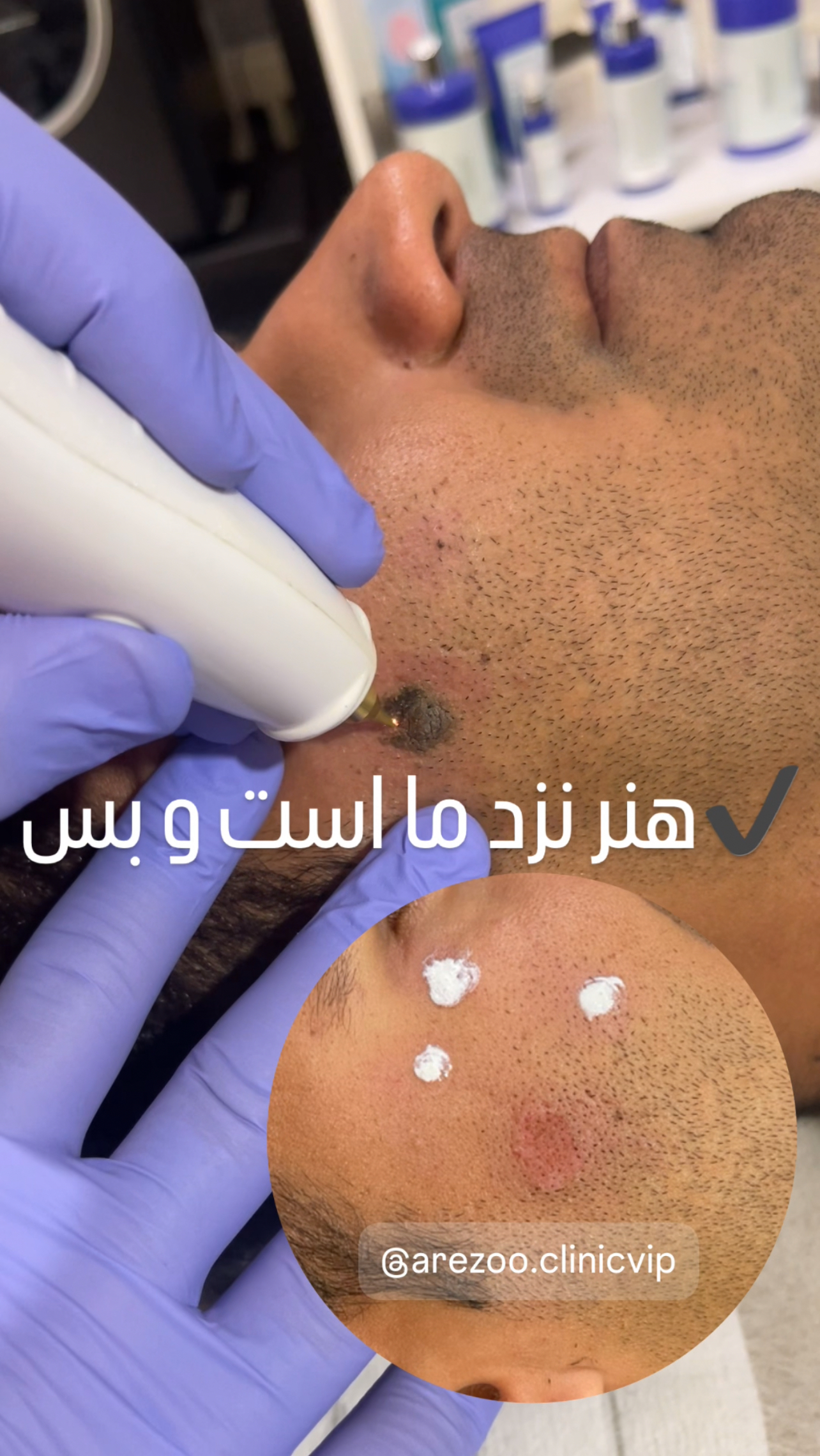 خالبرداری/ درمان زیگیل/ زائده های پوستی در اصفهان