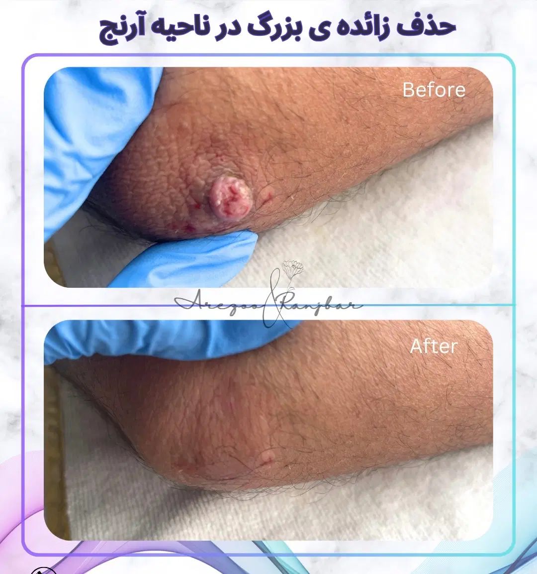 مشاوره رایگان%زگیل تناسلی% آقایان بانوان در اصفهان