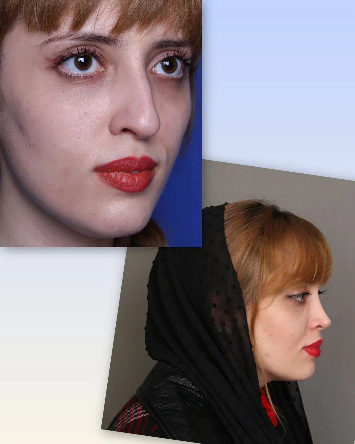 جراحی زیبایی بینی در مرکز زیبایی البرز تهران