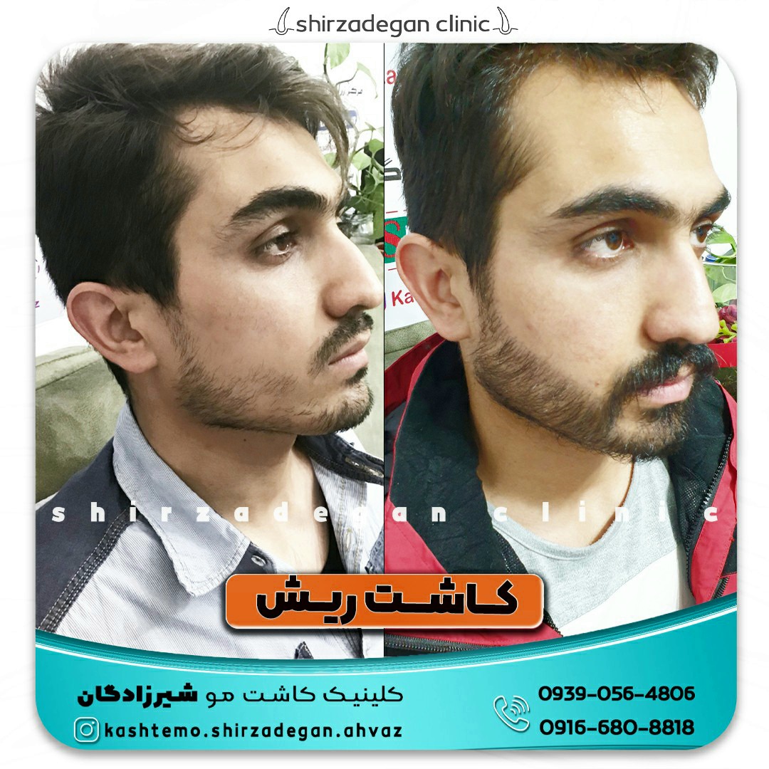 کاشت ریش شیرزادگان