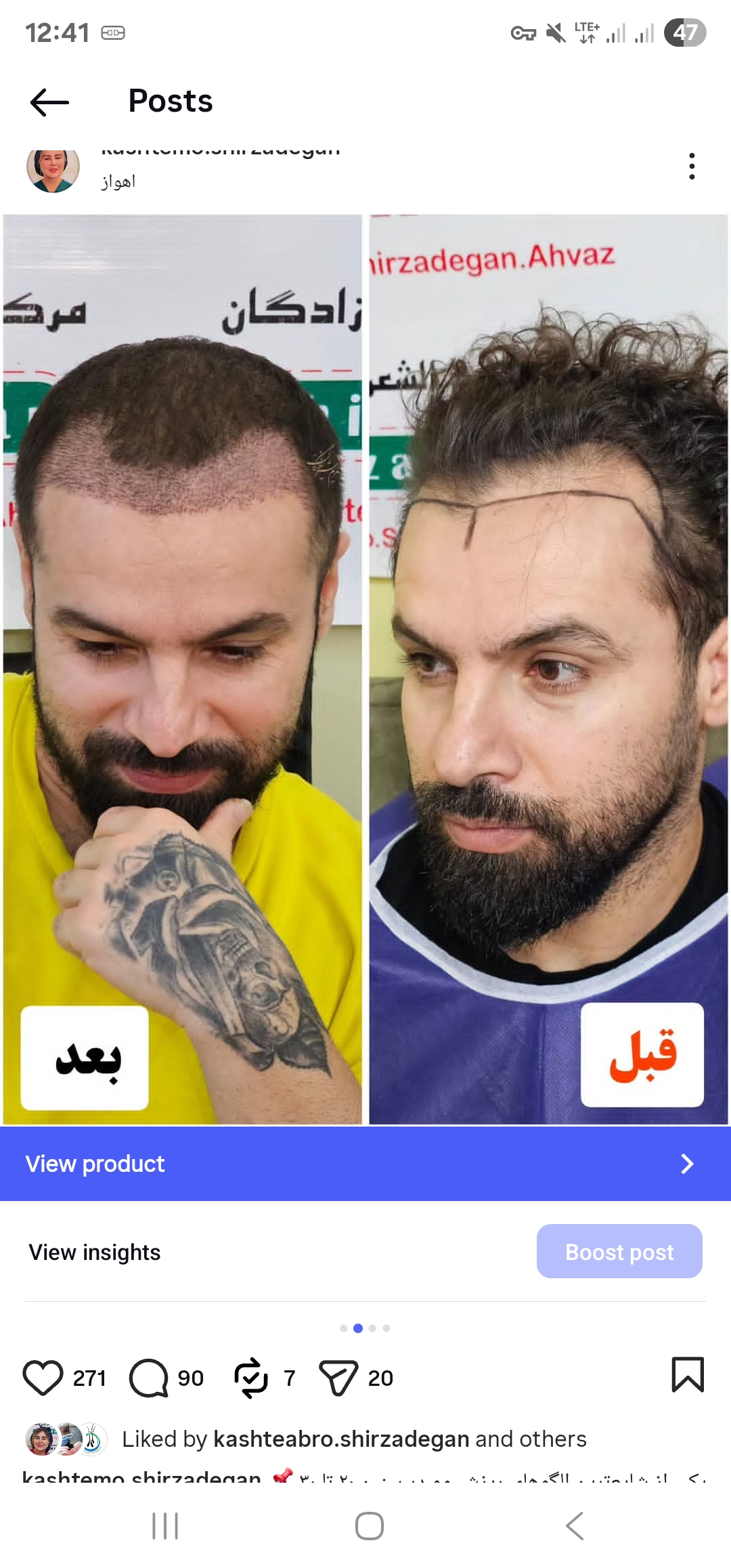 کاشت در ناحیه خط رویش
