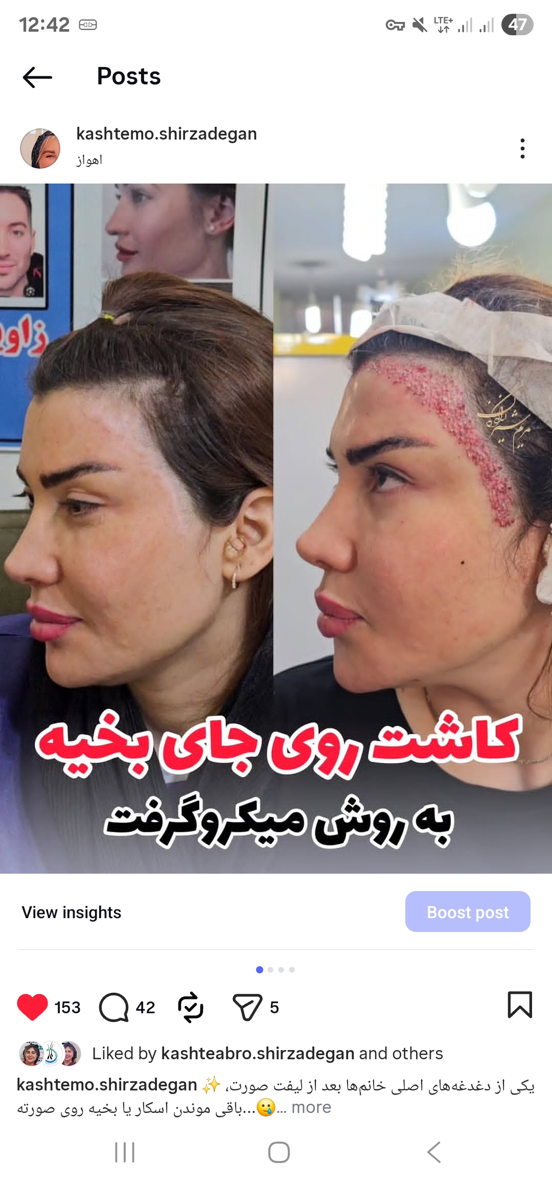 کاشت روی بخیه ، سوختگی و تصادف