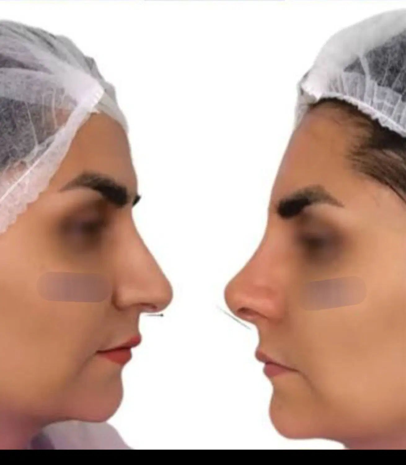 بوتاکس ژل لیفت نخ صورت بینی بلفاروپلاستی فیلر چرب