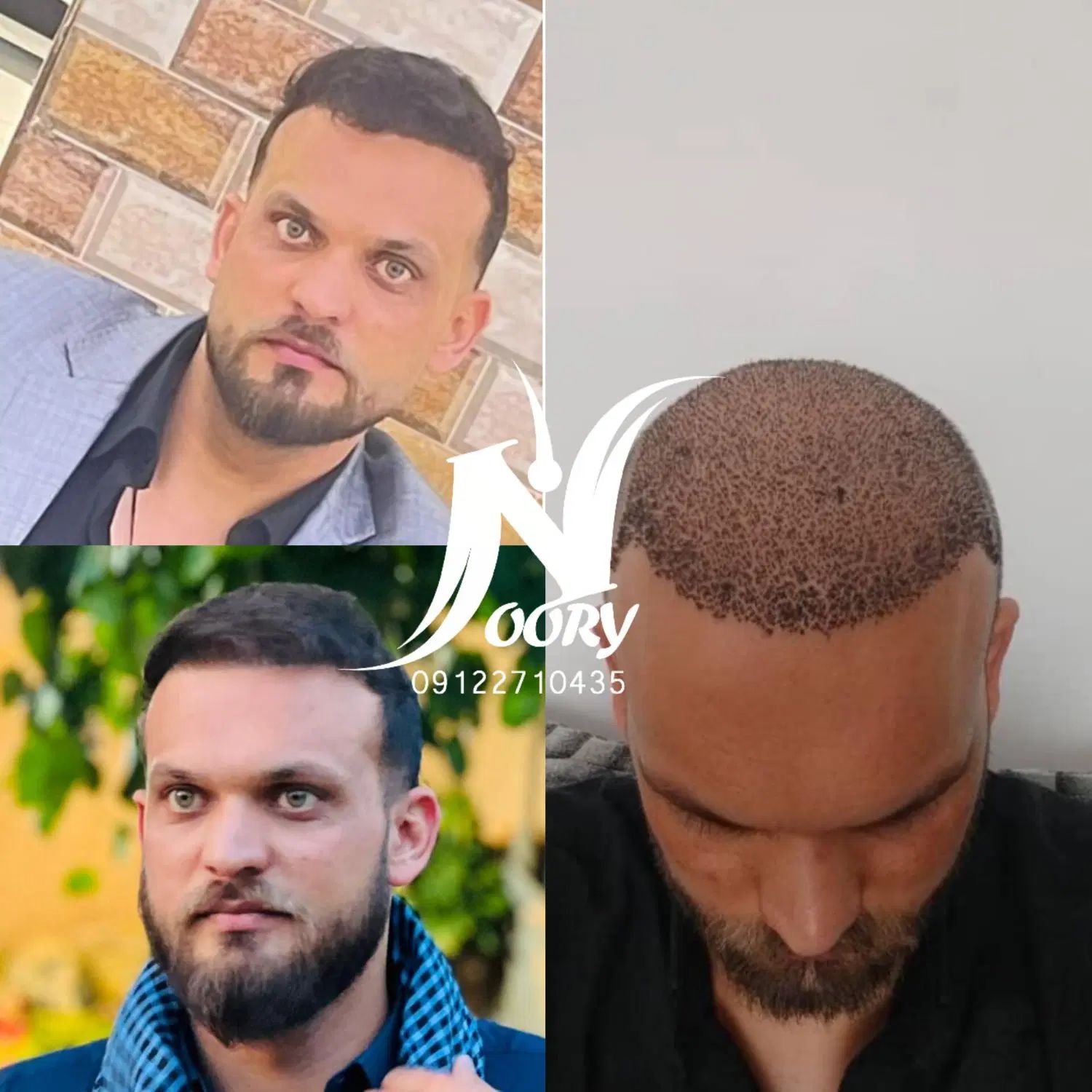 کاشت مو و ابرو