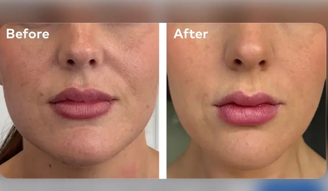 تخفیفات تزریق جالپرو پروفایلو و مزوژل جوانساز