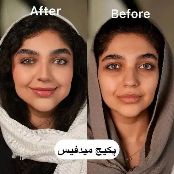 ۳۰٪تخفیف کمبوتکنیک چهره با خدمات رایگان توسط پزشک