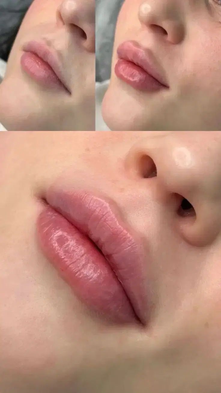 تزریق ژل و بوتاکس ،مزوژل