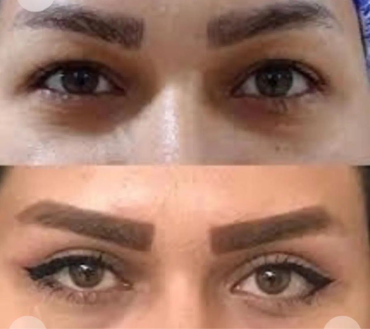 بلفارو،دایرکت ابرو،میدفیس،ساکشن اقساطی در کرج