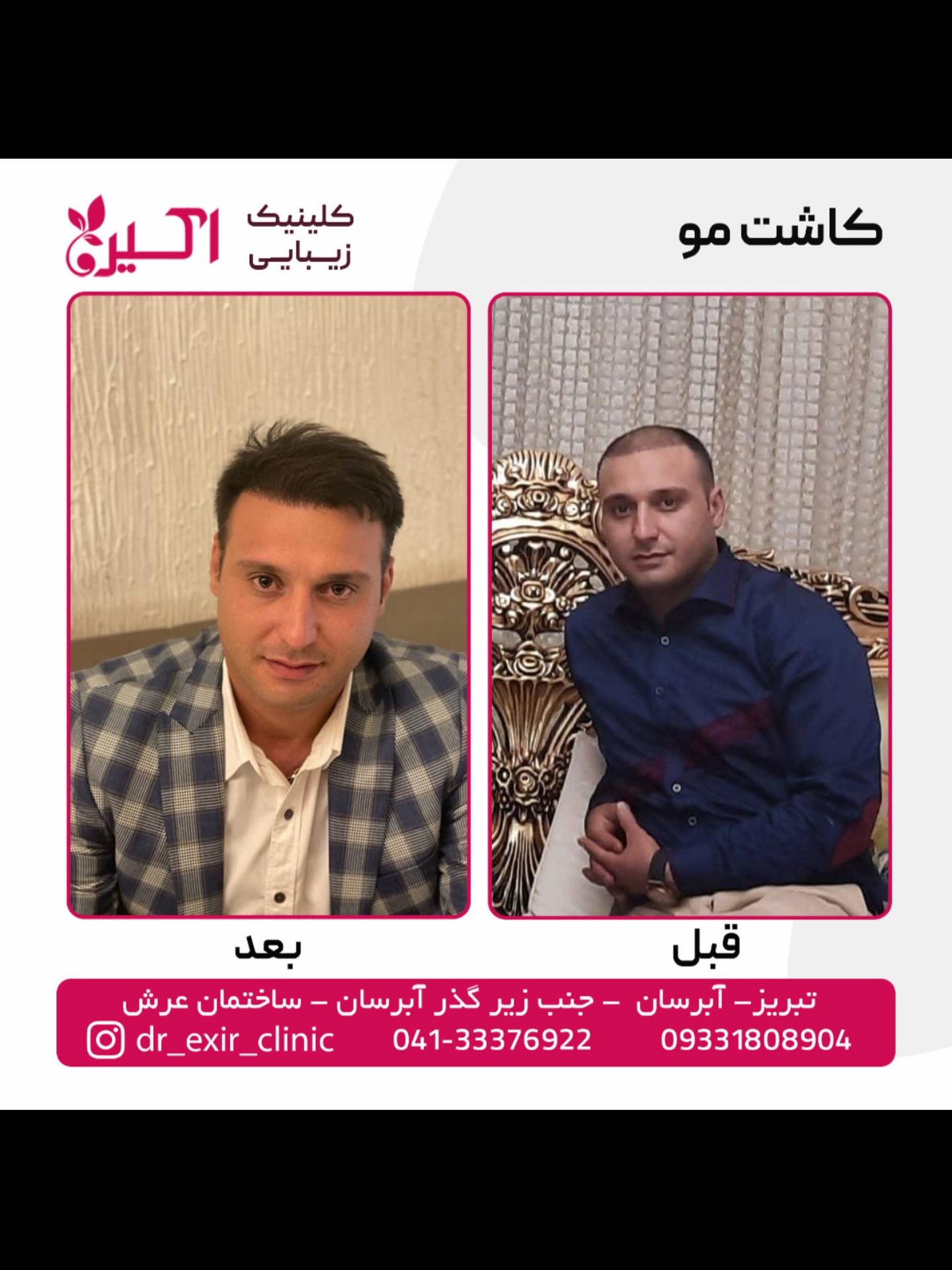 كلينيك تخصصي كاشت مو اكسير .