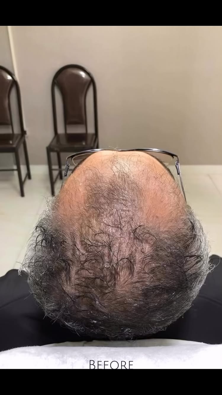 ریزش مو کلافه‌ت کرده؟ 😩💇🏻‍♀️