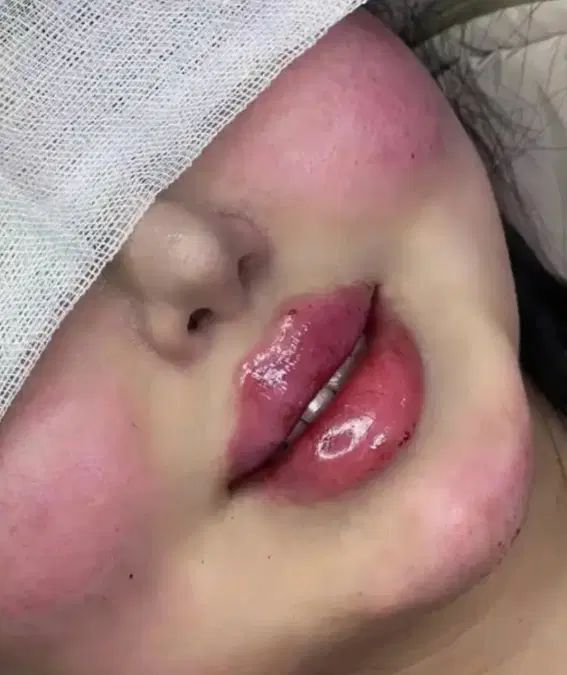 تزریق ژل فیلرلب.بوتاکس مزوژل فیلربادی باتخیفات 50٪