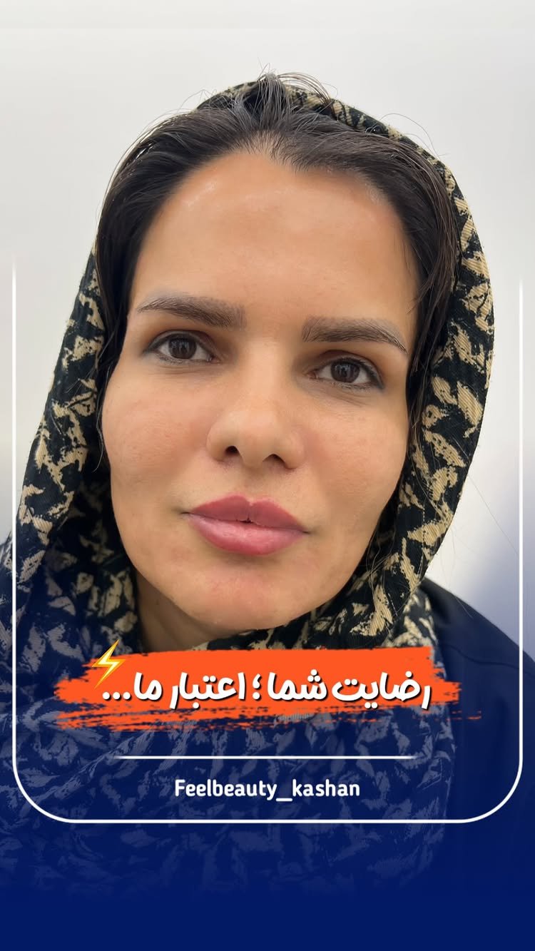  مراجعه جلسه دوم زیباجوی عزیزمون 😍🔥