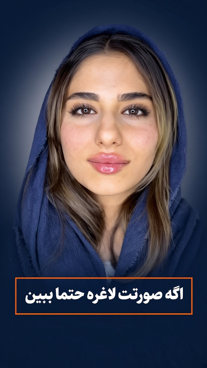  🔅بازگشت شادابی و جذابیت به چهره فقط با تزریق چند نقطه کوچیک در صورت 🔅