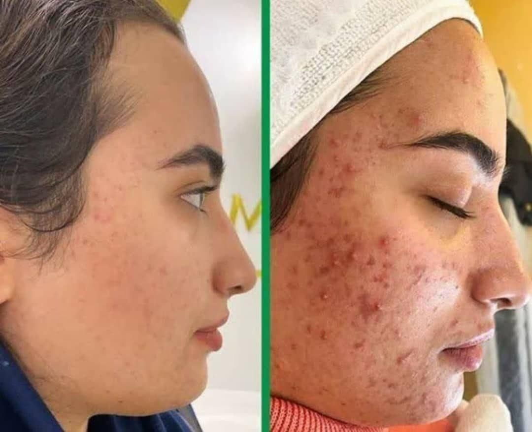 زیبایی/ر رفع جوش/ لاغری