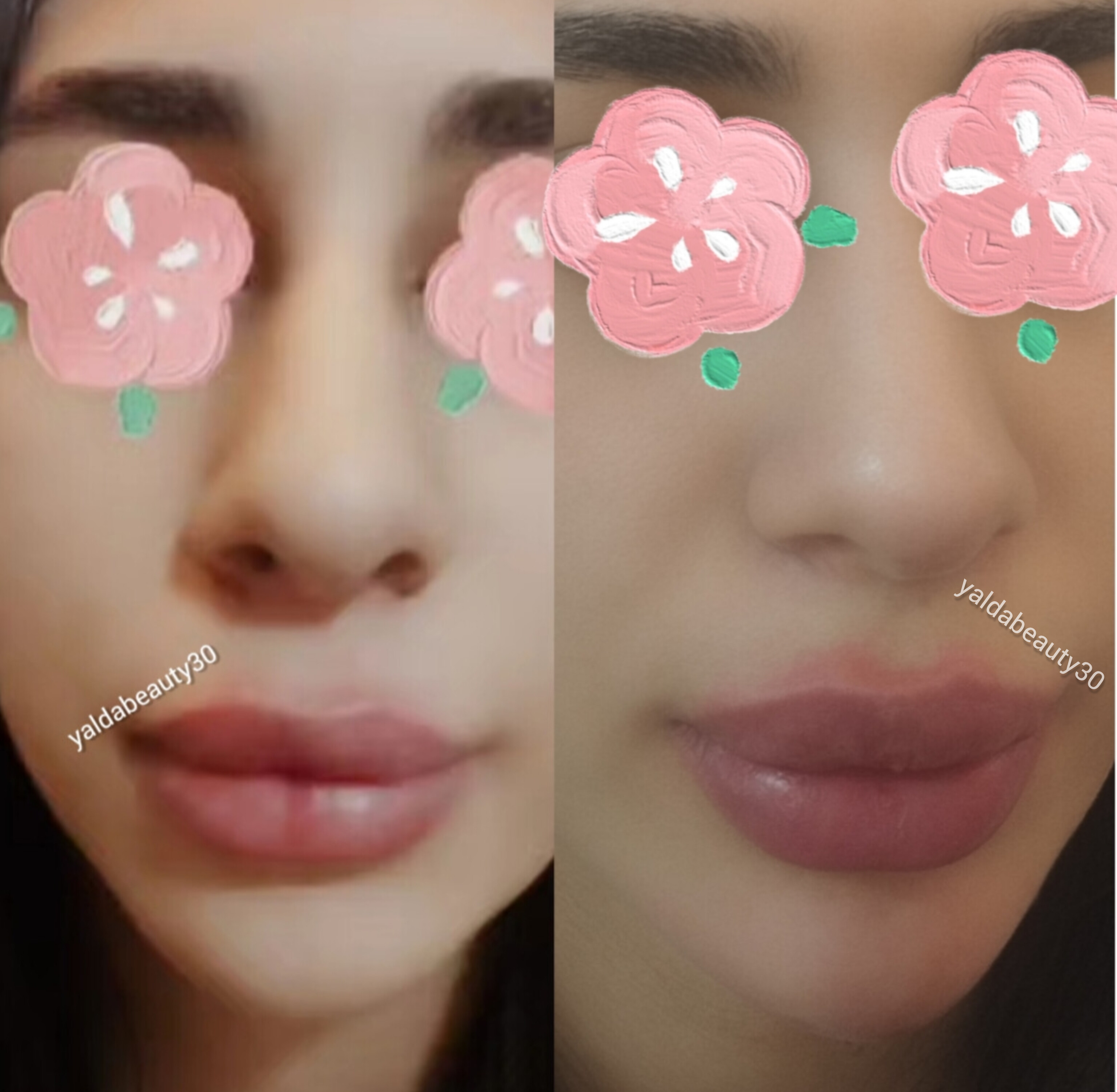فیلر لب و چانه