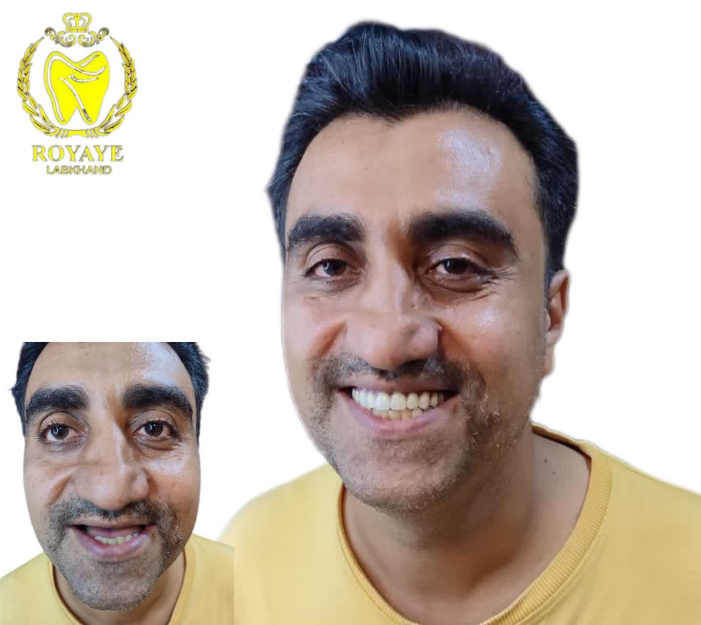 دست دندان کامل فک بالا
