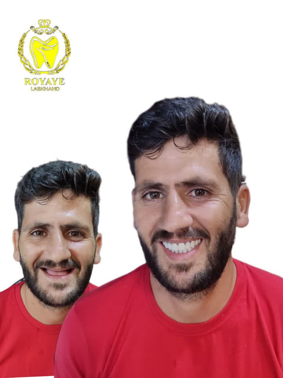 دست دندان کامل (فول دنچر)