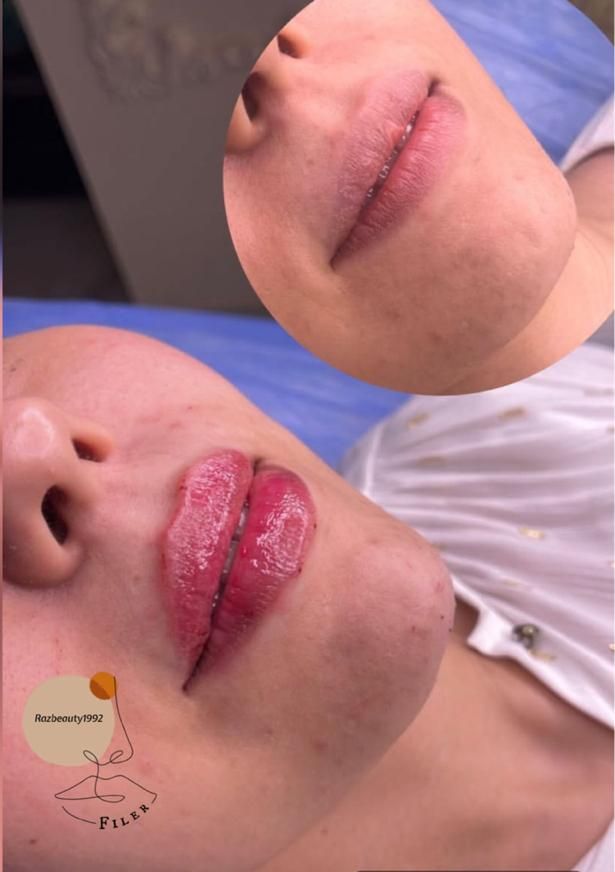 جوانسازی و زیبایی صورت با تزریق ژل و فیلر
