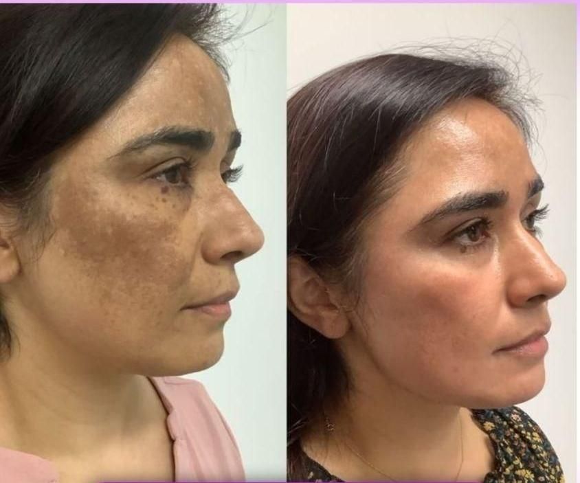 لیزر co2ترکیبی تک جلسه ای