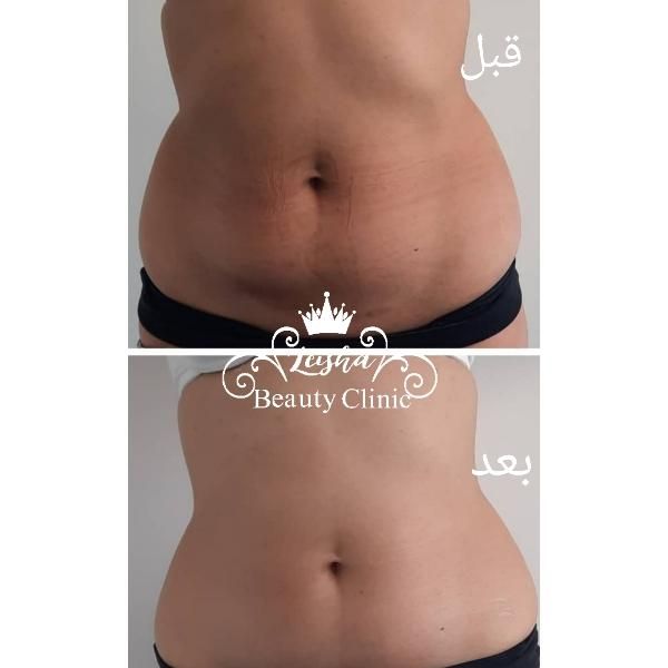 کلینیک تخصصی لاغری تضمینی،هایفو،ژل،بوتاکس