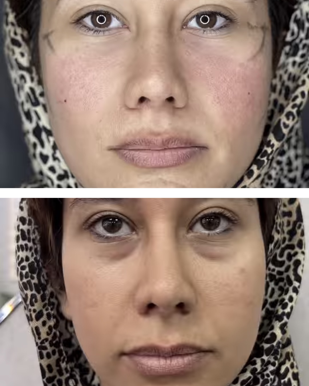 فیلر زیرچشم، گونه و روشن کننده زیرچشم