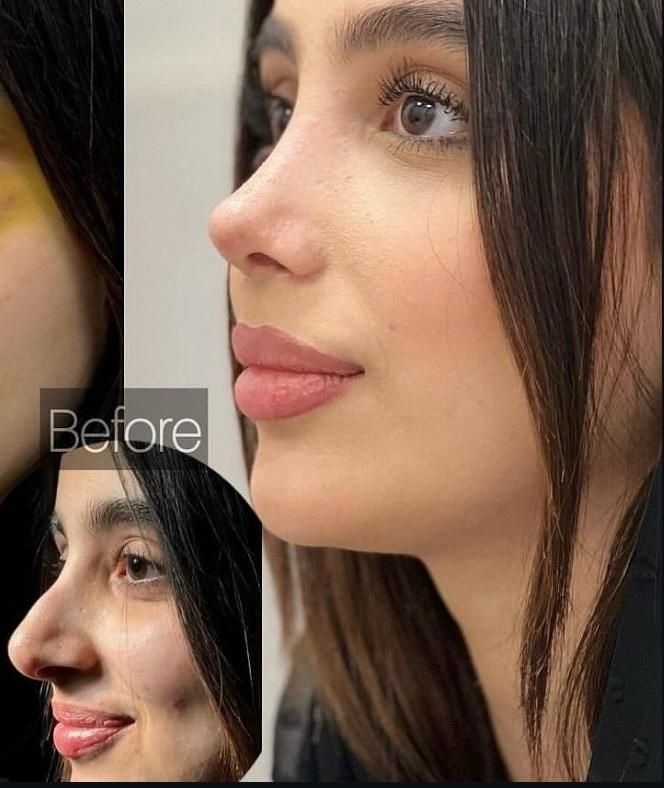 عمل جراحی بینی لیپو ابدو لیفت پروتز چربی