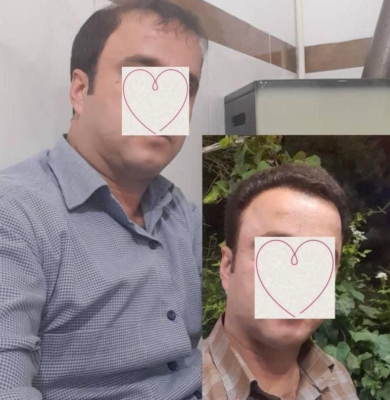 کاشت مو ابرو ریش توسط متخصص پوست و مو