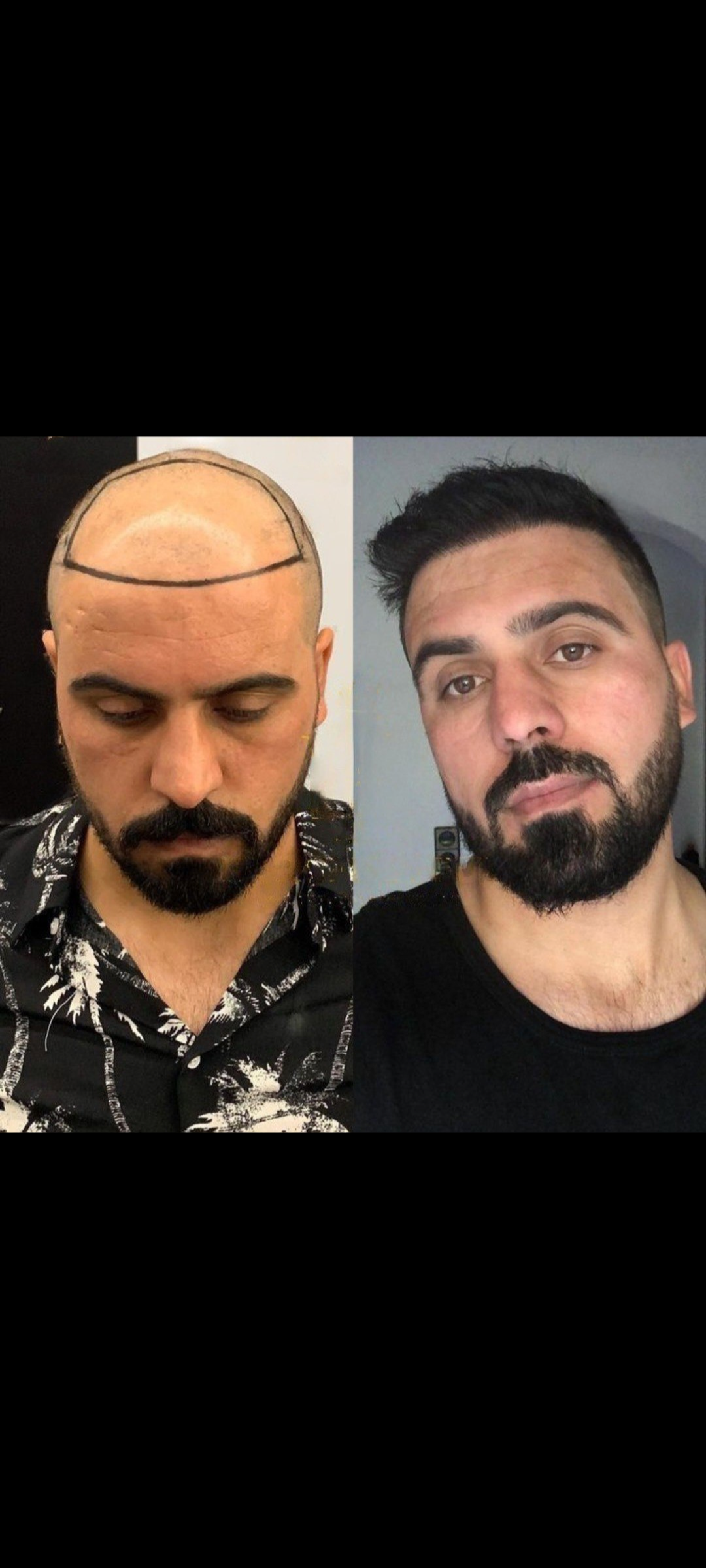 جشنواره کوتاه مدت کاشت مو در تهران