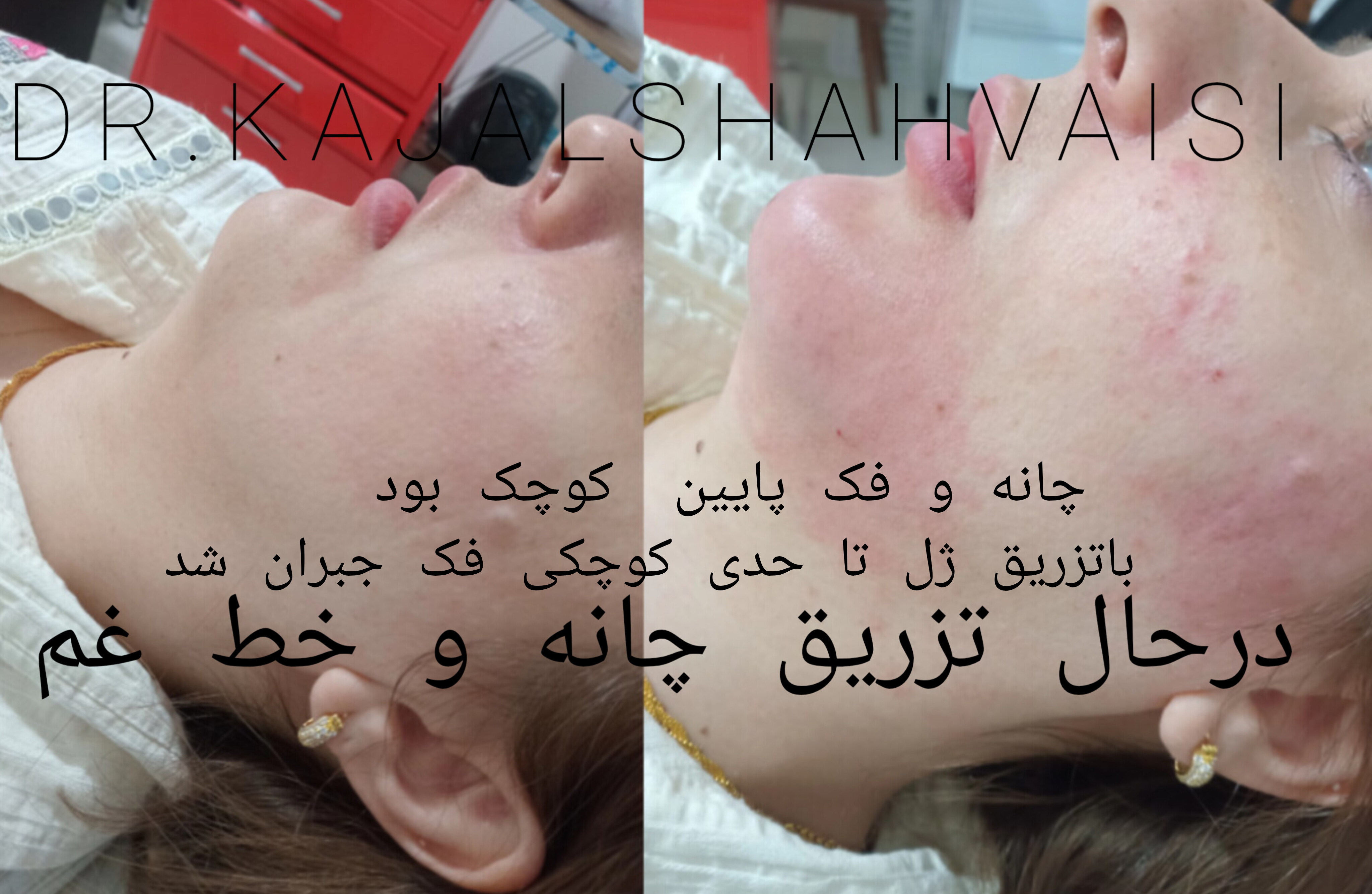 تزریق ژل بوتاکس مزوژل جوانساز در مطب خانم دکتر شاه ویسی