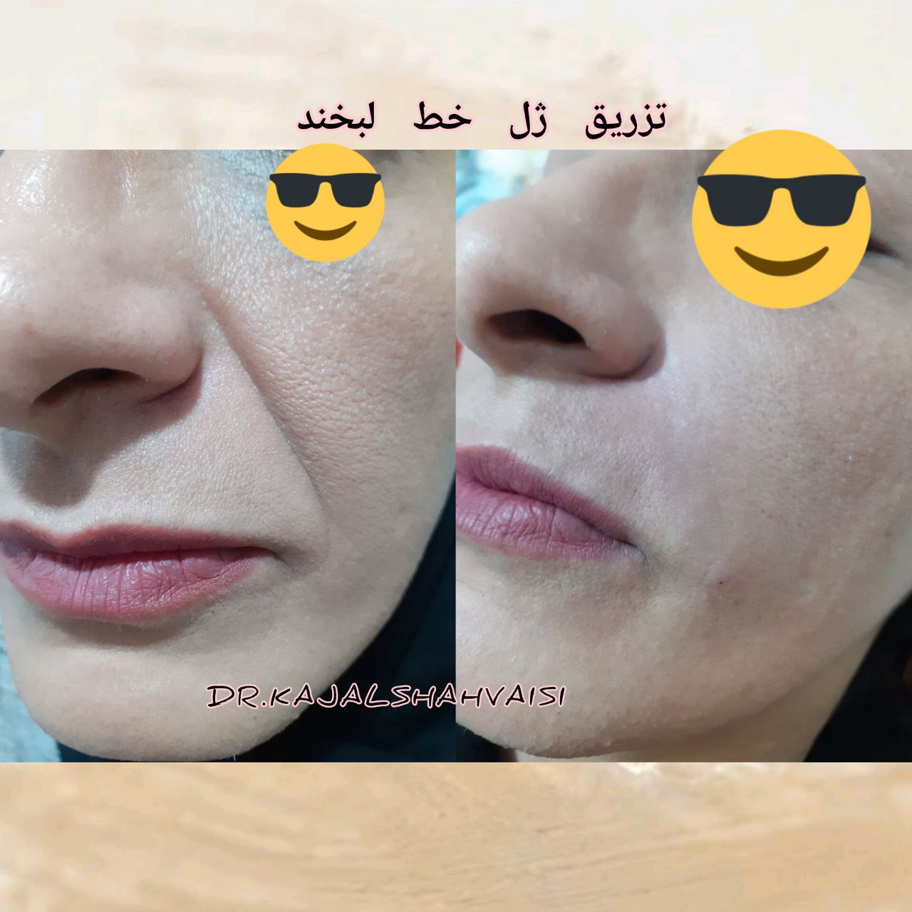 تزریق تخصصی ژل بوتاکس و جوانساز در مطب خانم دکتر