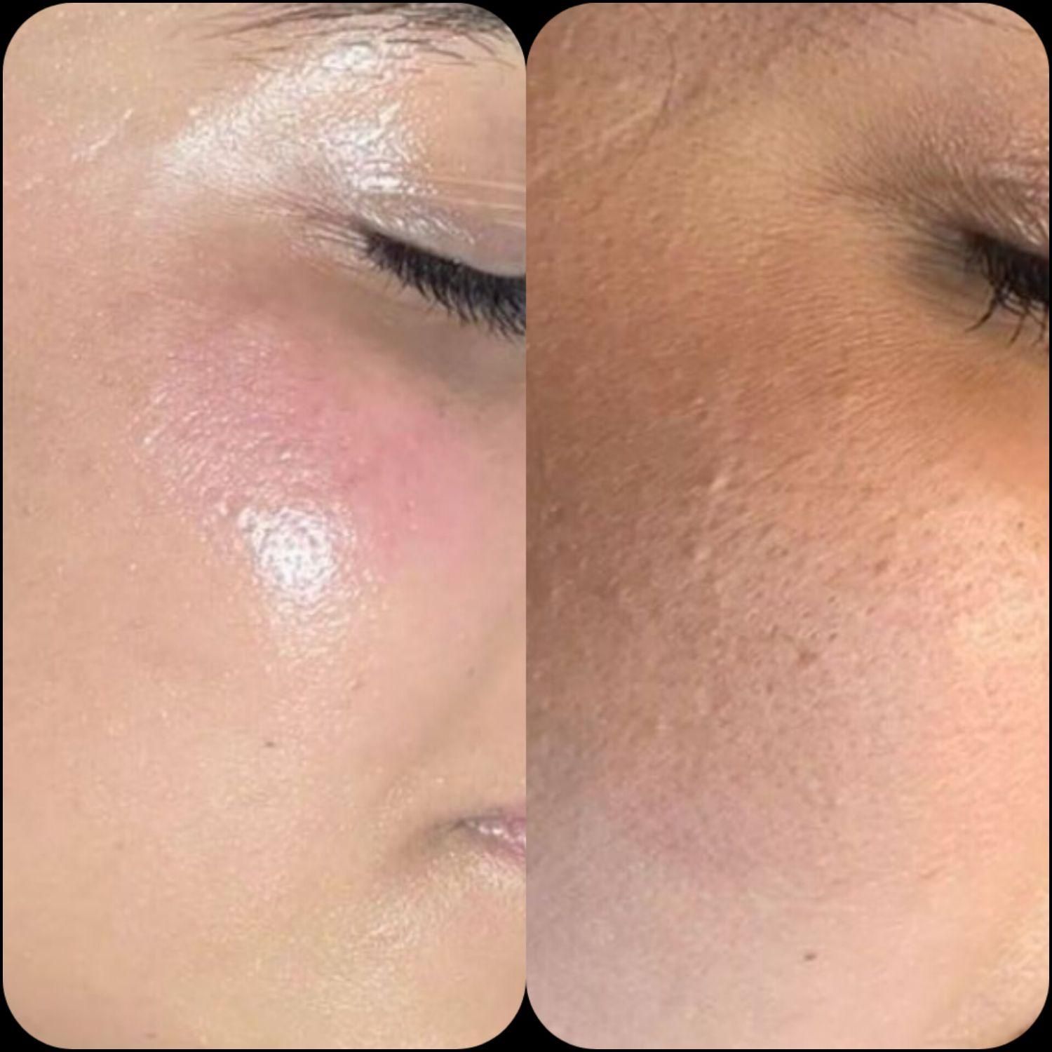 کوکتل تراپی برای مشکلات پوستی و رفع تیرگی بدن
