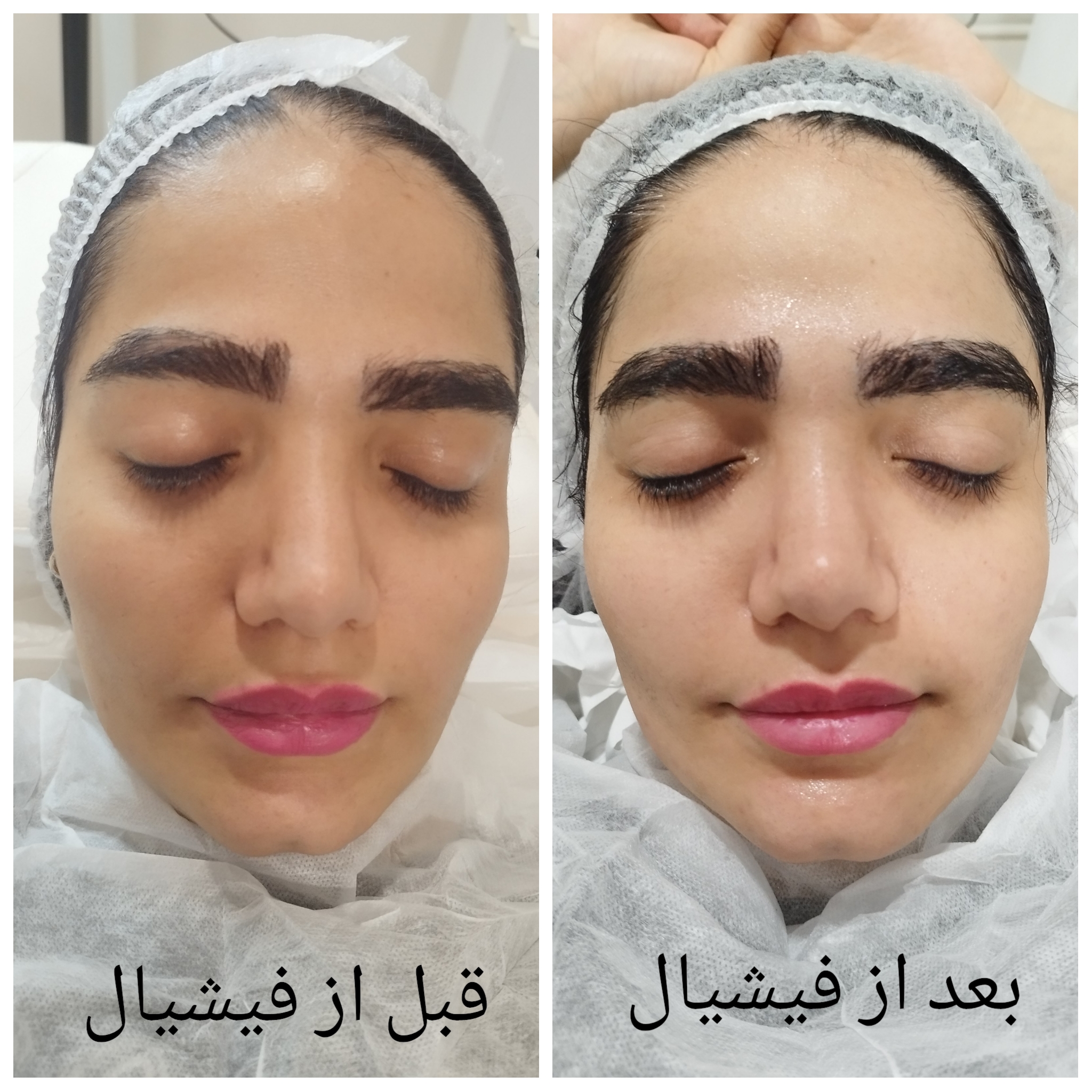 فیشیال روشن سازی