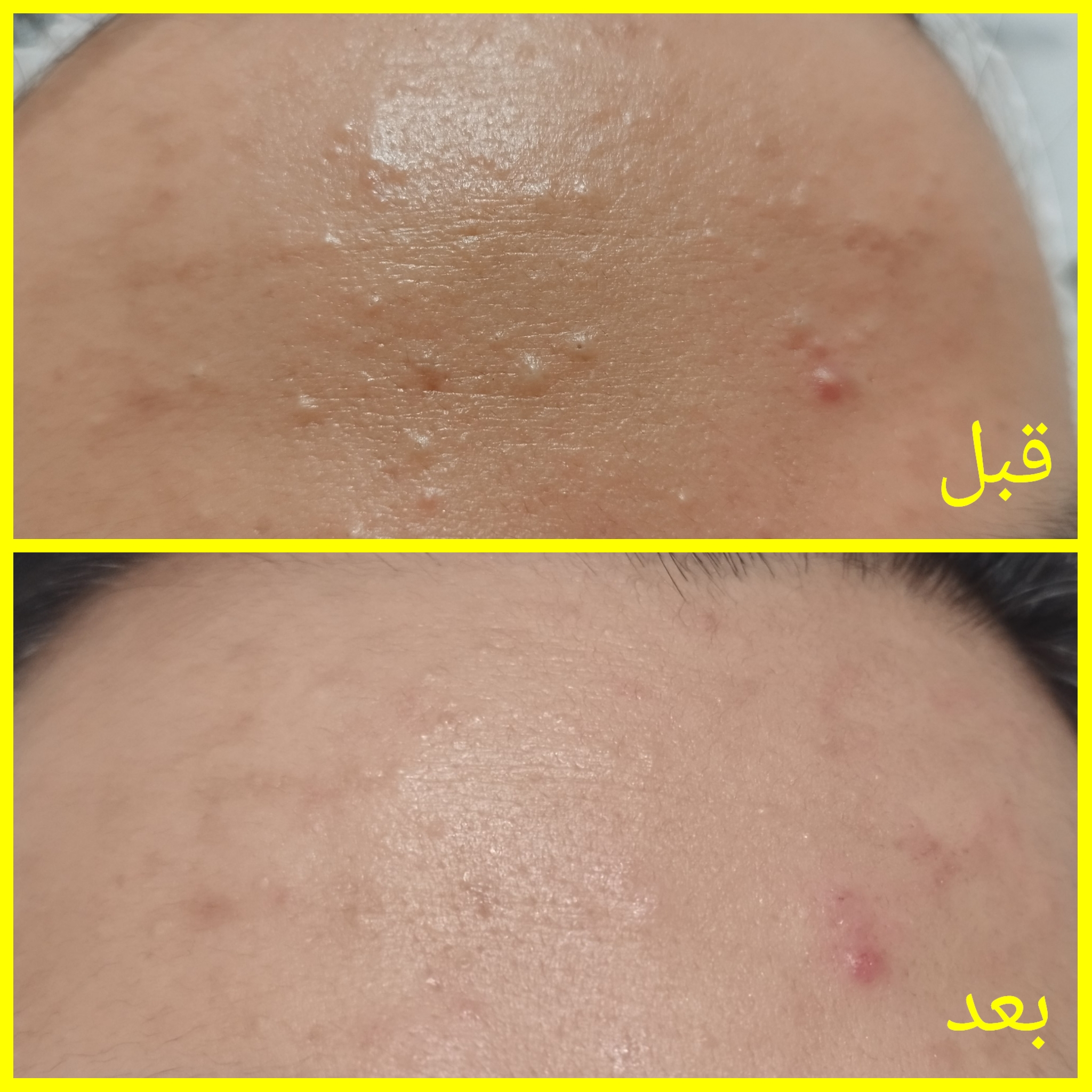 فیشیال رفع جوش