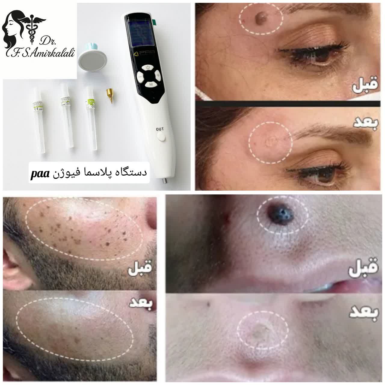 خال برداری با دستگاه پلاسما فیوژن paa