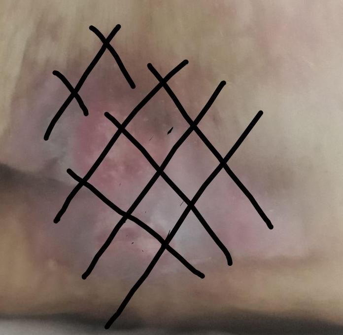 خدمات پرستاری در منزل(تخصصی زخم بستر و دیابتی)