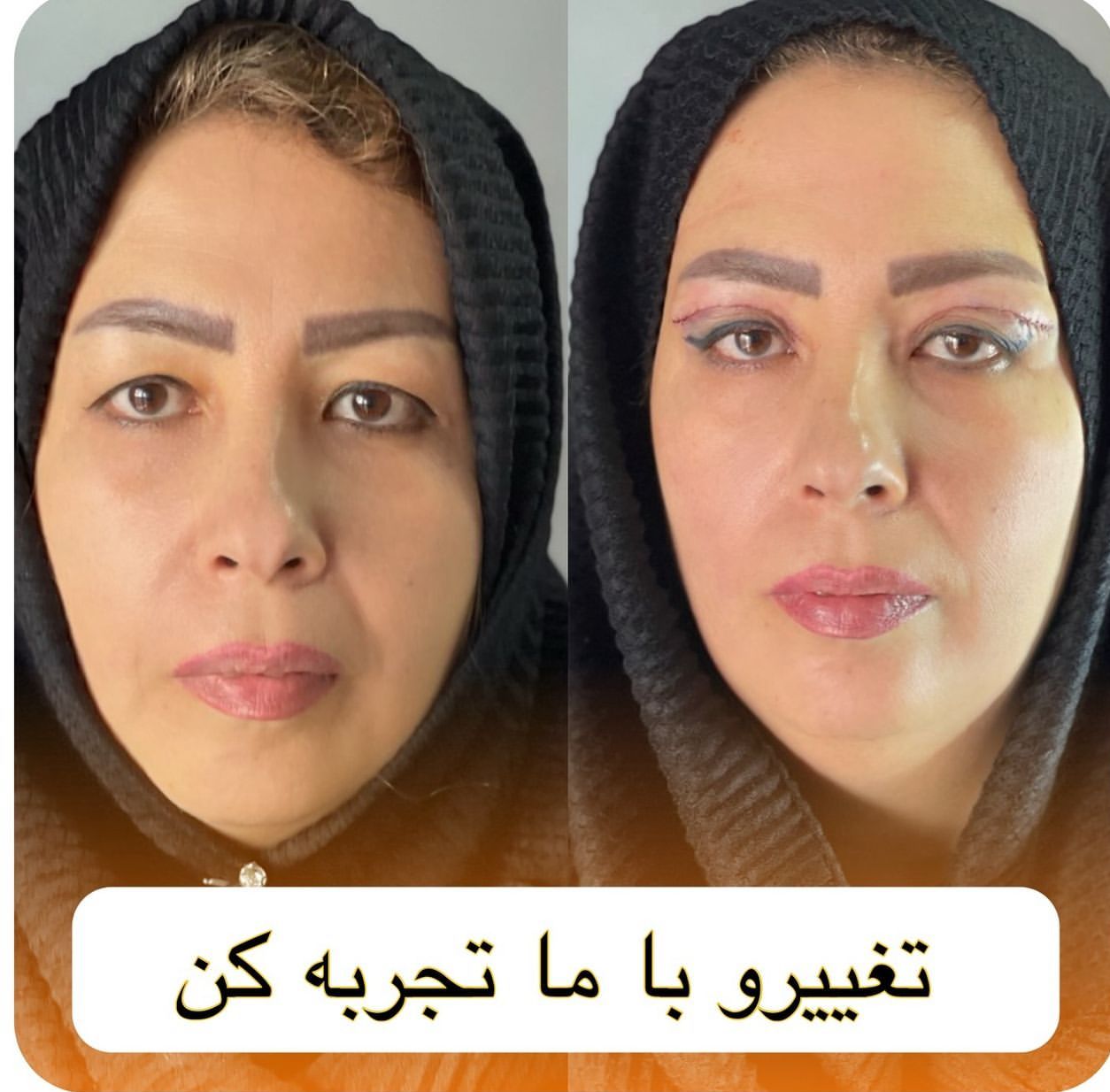بلفاروپلاستی(جراحی پلک)