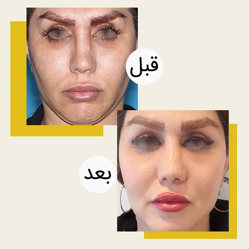لیفت گونه اندوسکپ