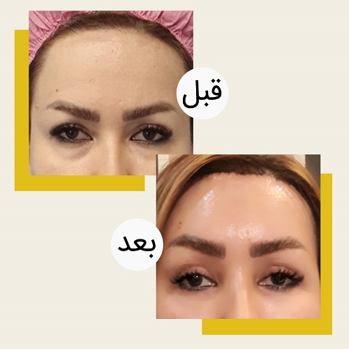 لیفت پیشانی اندوسکوپیک