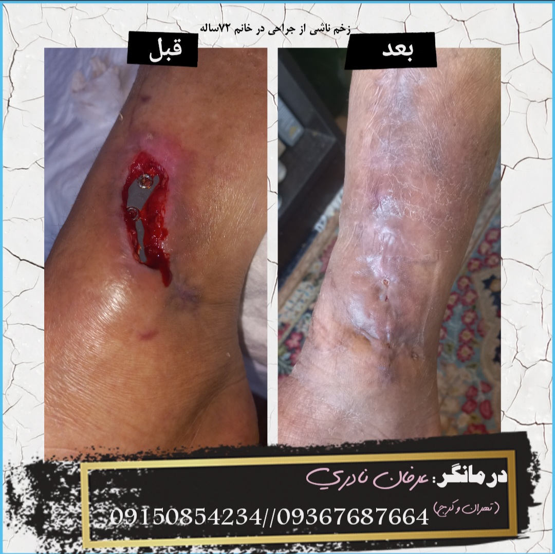 درمان زخم ناشی از عفونت محل جراحی