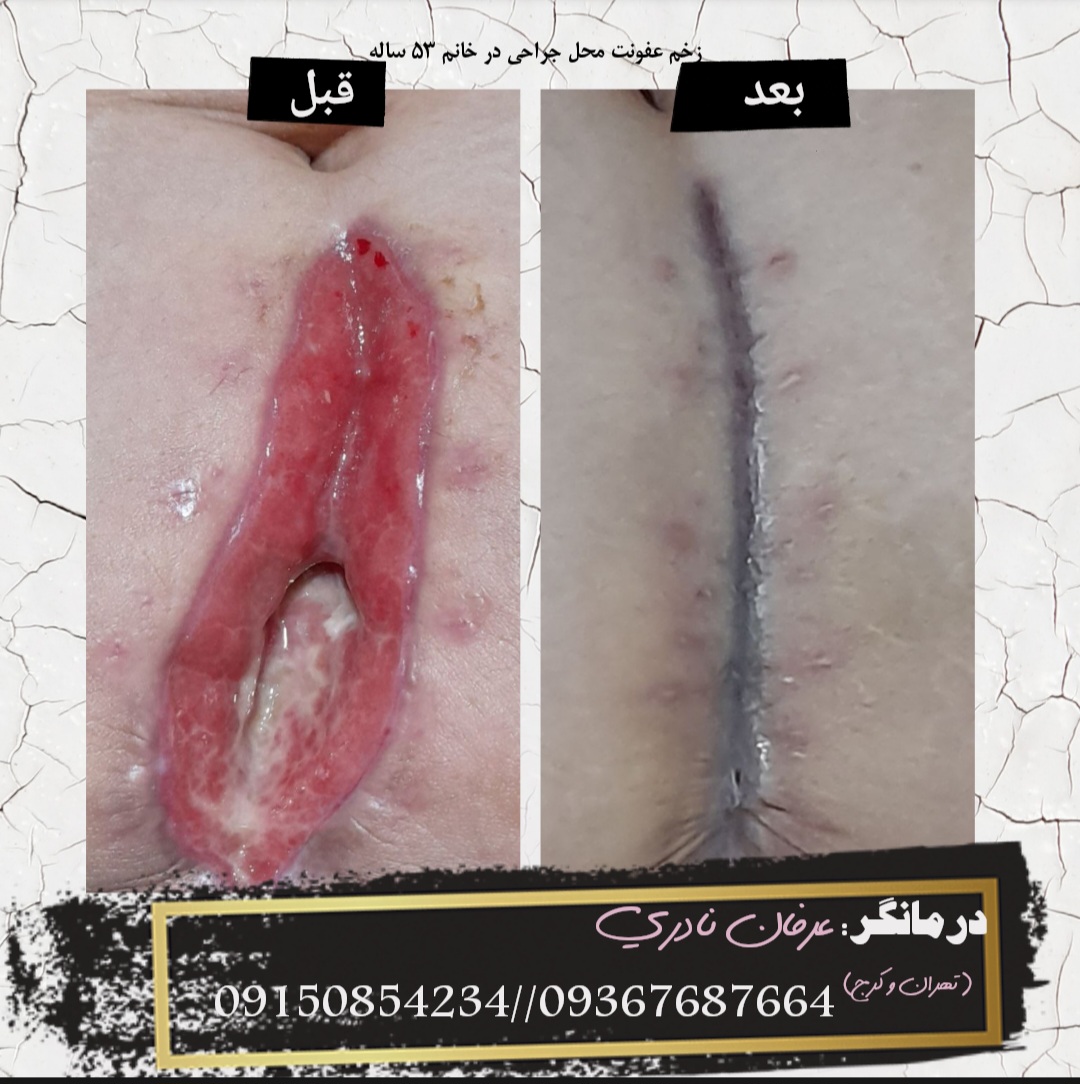 عفونت محل جراحی