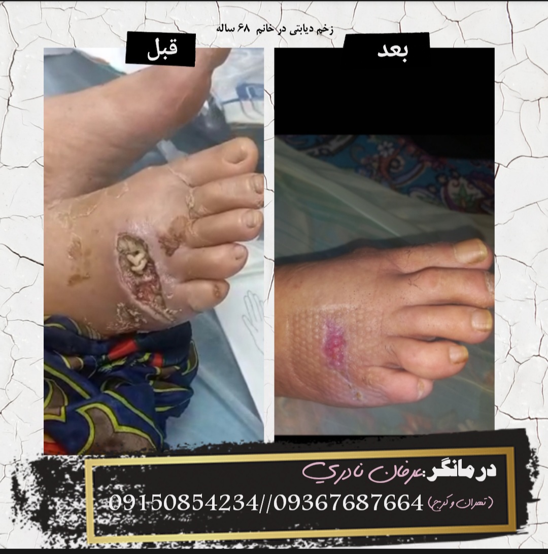 درمان زخم پای دیابتی