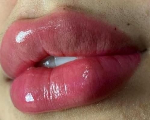 خدمات ژل وبوتاکس ورنگ