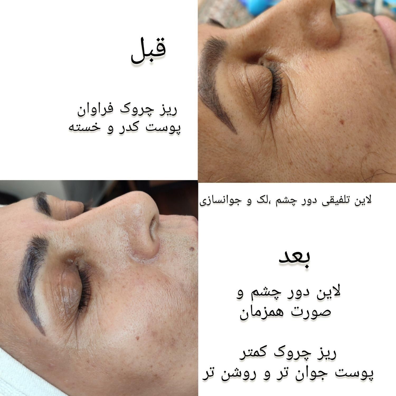 فیشال تخصصی پوست(پاکسازی درمانی)بانوان در مشهد