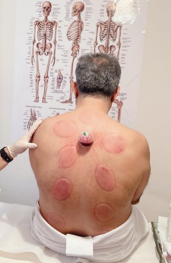 حجامت و خدمات تخصصی طب سنتی