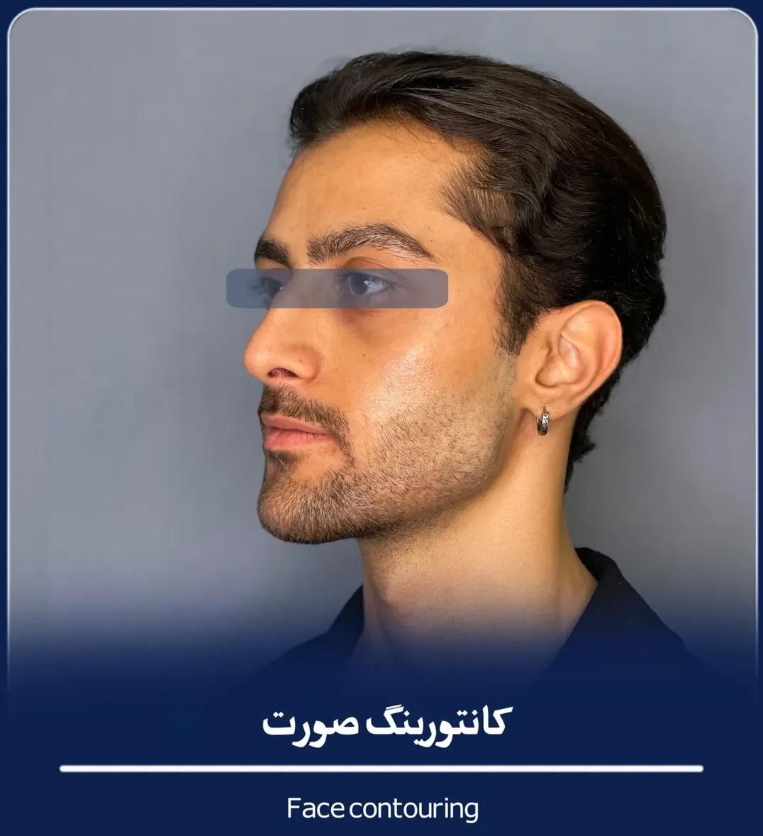 فیلر بادی ژل لب بوتاکس لیفت بلفاروپلاسی بوکال فت