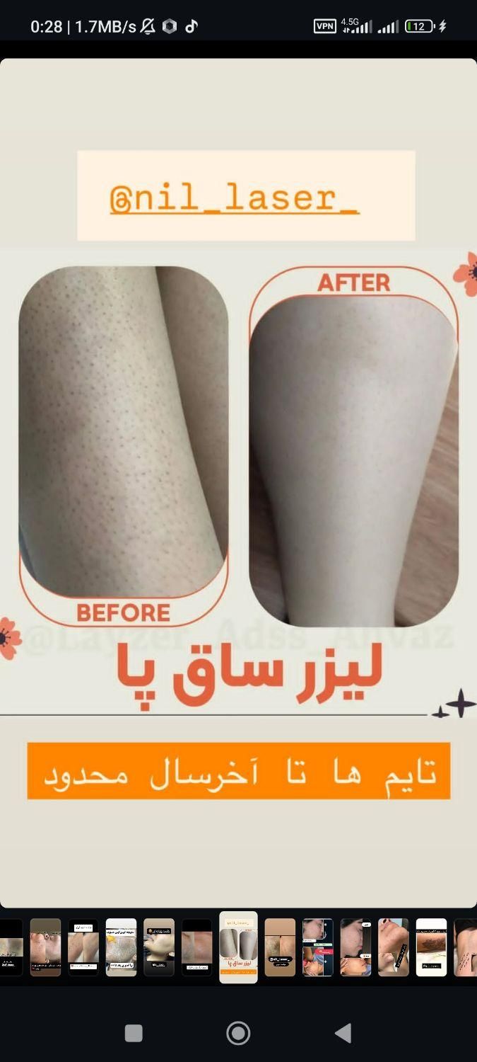 مرکز لیزر موج کندلا زائد لیزر بانوان لیزر آقایان